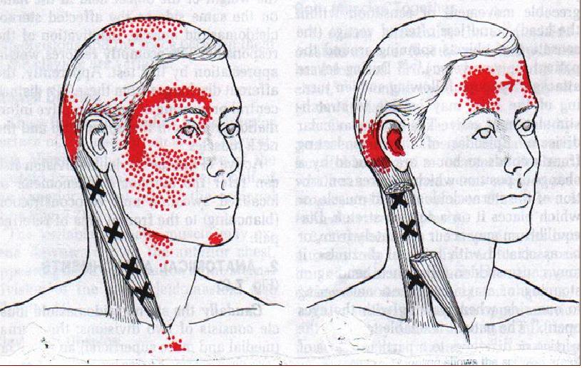 Trigger Points: cosa sono, come trattarli, sintomi e terapia